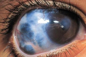 Діагностика та ознаки глаукоми